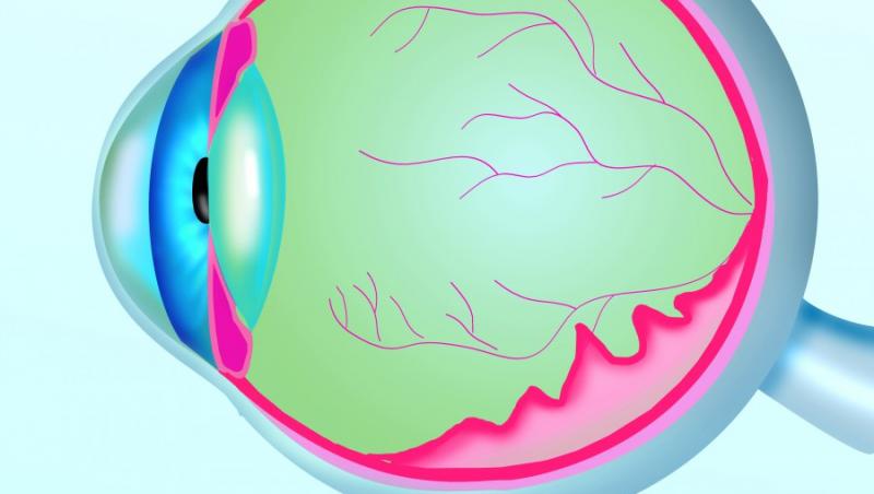 VIDEO! S-a inventat irisul artificial