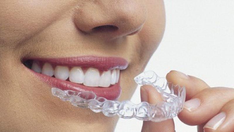 VIDEO! Aparatele dentare asigura frumusetea dintilor tai