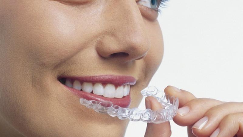 VIDEO! Aparatele dentare asigura frumusetea dintilor tai