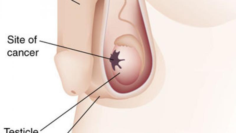 Trei mituri despre cancerul testicular
