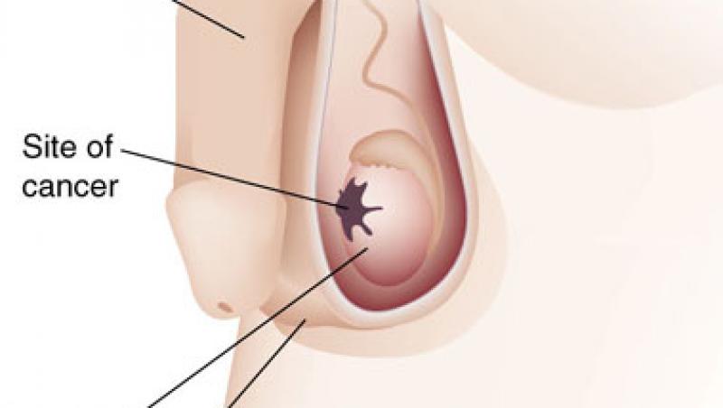 Trei mituri despre cancerul testicular
