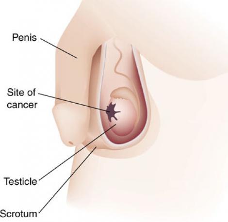 Trei mituri despre cancerul testicular