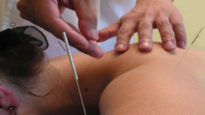 Mentine-ti silueta cu acupunctura!