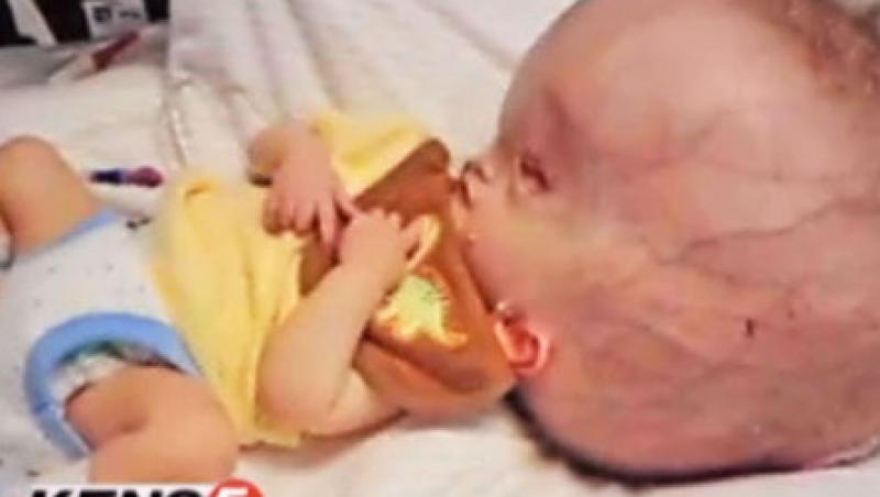 VIDEO! Bebelus nascut cu un cap gigantic