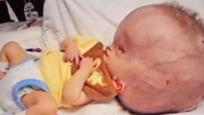 VIDEO! Bebelus nascut cu un cap gigantic