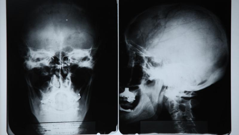 Radiografie craniana a lui Albert Einstein, vanduta cu peste 28.000 de euro