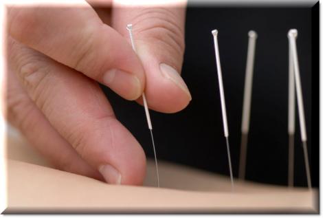 Slabeste folosind acupunctura!