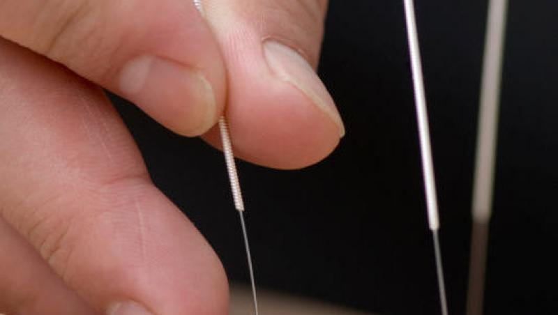 Slabeste folosind acupunctura!