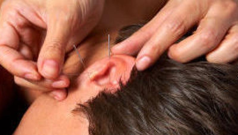 Acupunctura in ureche, o alta metoda de a slabi