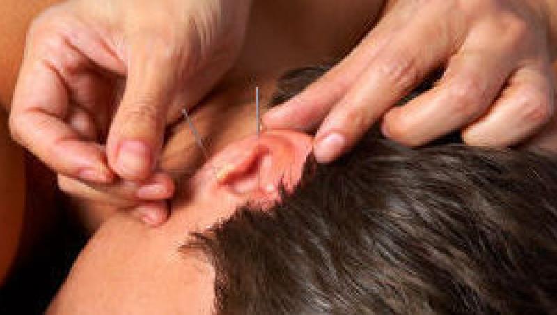 Acupunctura in ureche, o alta metoda de a slabi
