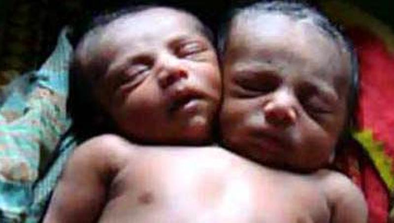 India: Un copil s-a nascut cu doua capete