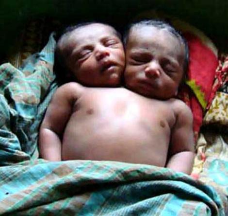 India: Un copil s-a nascut cu doua capete