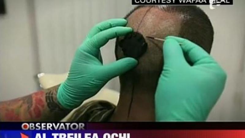 VIDEO! Un barbat si-a pus un ochi artificial la ceafa