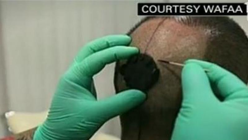 VIDEO! Un barbat si-a pus un ochi artificial la ceafa