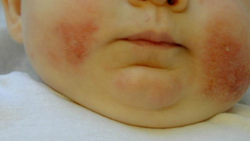 Copilarie cu restrictii: dermatita atopica