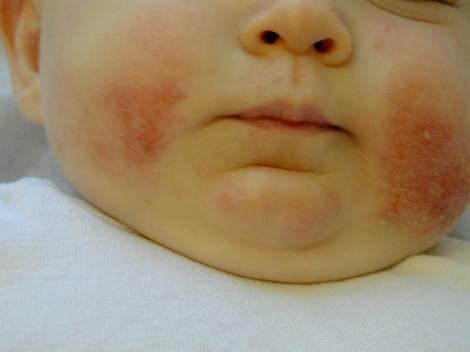 Copilarie cu restrictii: dermatita atopica