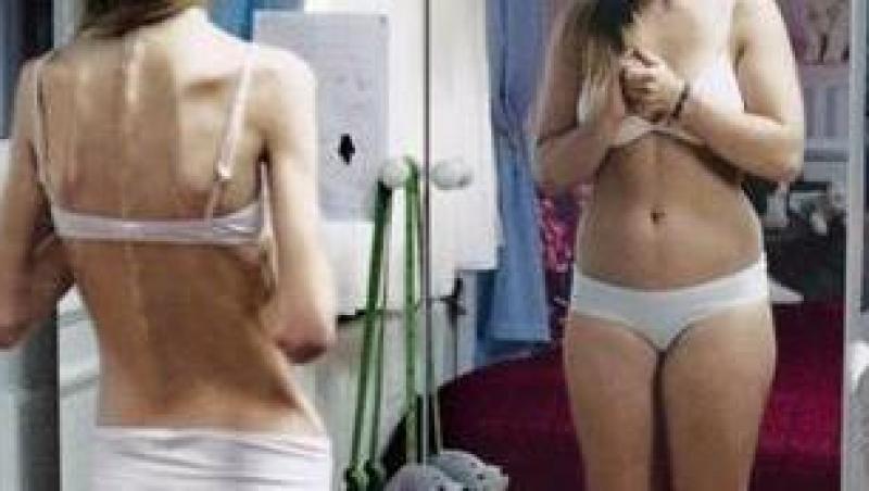 Anorexicii si bulimicii pot primi ajutor in Franta