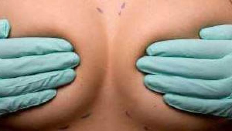 Cand schimbam implantul mamar?