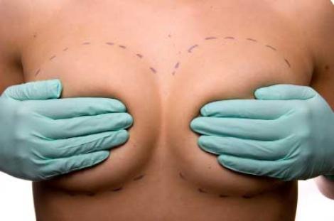 Cand schimbam implantul mamar?