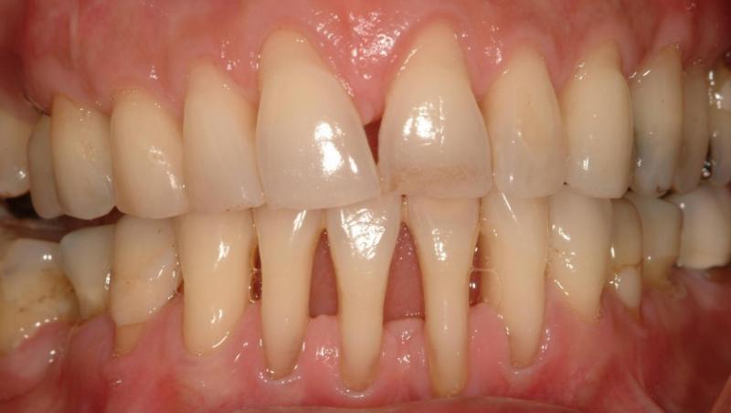 VIDEO! Parodontoza - boala dintilor frumosi