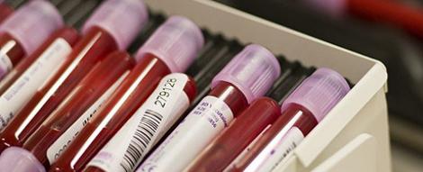 Ciroza poate fi diagnosticata printr-un simplu test de sange