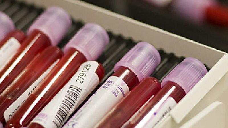 Ciroza poate fi diagnosticata printr-un simplu test de sange
