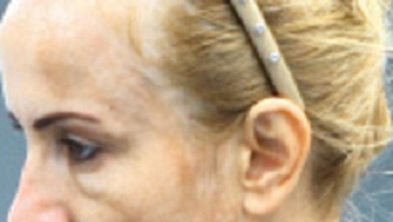 FOTO! Daniela Gyorfi, desfigurata dupa un tratament facial!