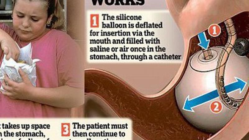 Balonul gastric, cea mai noua inventie care te ajuta sa slabesti!