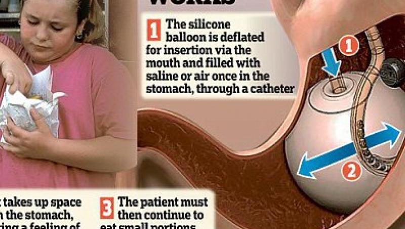 Balonul gastric, cea mai noua inventie care te ajuta sa slabesti!