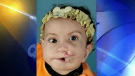 VIDEO! Fetita cu doua guri a fost operata