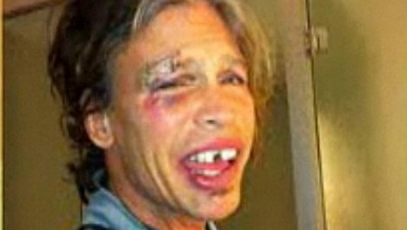 VIDEO! Vezi cum arata Steven Tyler cu ochiul vanat si dintii sparti!
