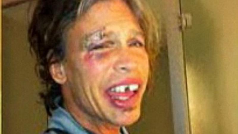 VIDEO! Vezi cum arata Steven Tyler cu ochiul vanat si dintii sparti!