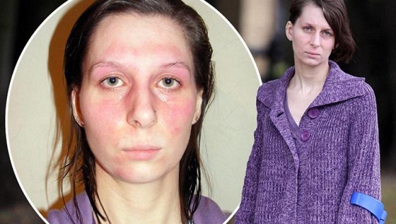 FOTO! Femeia cu 75 de alergii, prizoniera propriului corp!