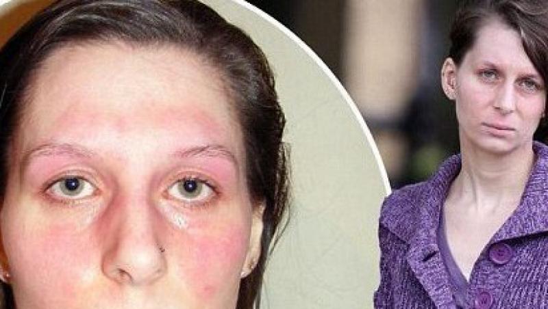 FOTO! Femeia cu 75 de alergii, prizoniera propriului corp!