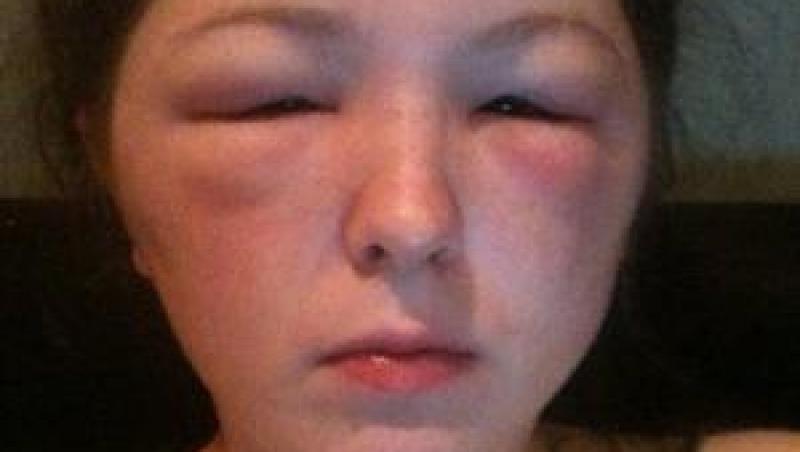 FOTO! O adolescenta a fost mutilata de vopseaua de par