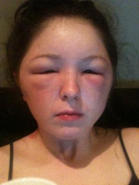FOTO! O adolescenta a fost mutilata de vopseaua de par