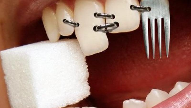 7 mituri despre implantul dentar