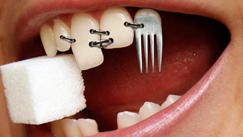 7 mituri despre implantul dentar