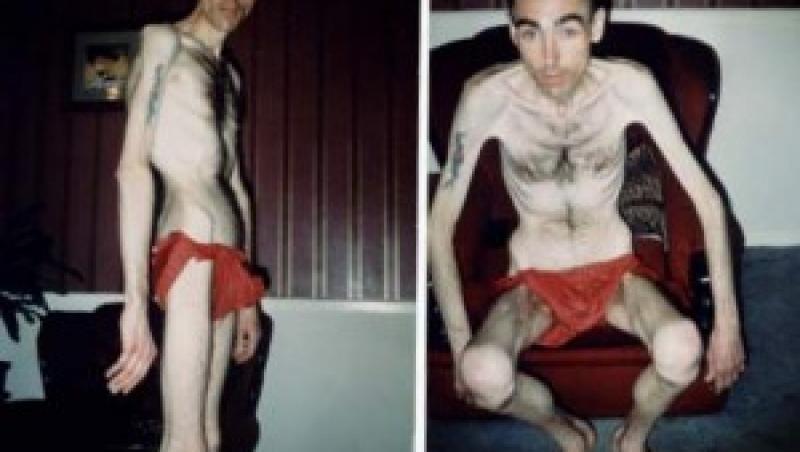 FOTO! Vezi cum arata un barbat, din cauza anorexiei!