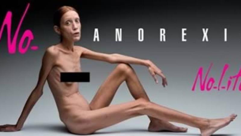 FOTO! Vezi cele mai SOCANTE cazuri de anorexie!
