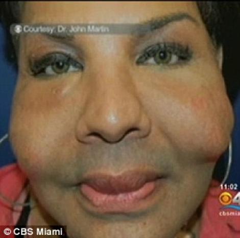 Un transsexual a cazut victima implanturilor cu ciment in pometi!