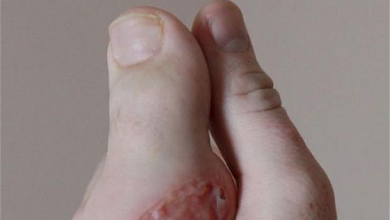FOTO! Un barbat care si-a pierdut degetul de la o mana si-a cusut in loc un deget de la picior