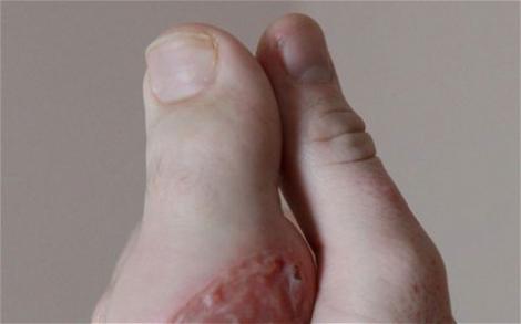 FOTO! Un barbat care si-a pierdut degetul de la o mana si-a cusut in loc un deget de la picior