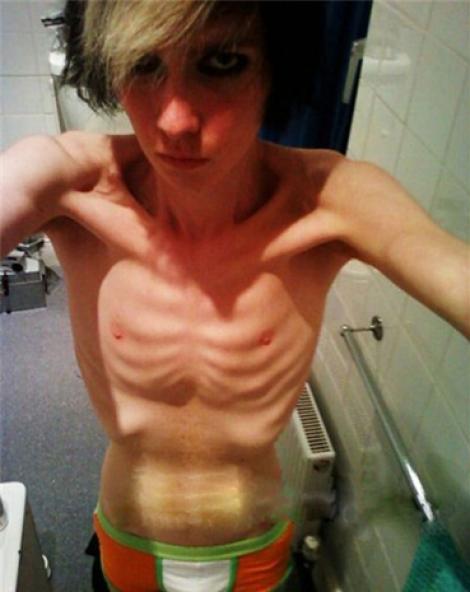 Marea Britanie: La 16 ani a devenit anorexic, pentru ca dorea sa fie model