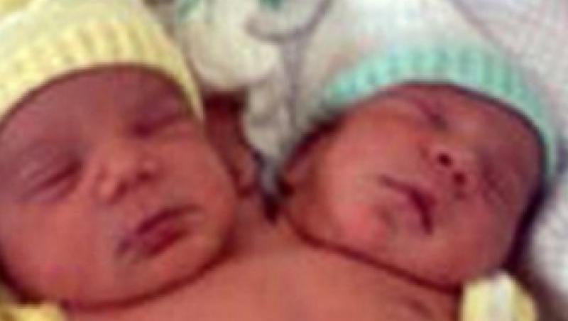Brazilia: s-a nascut un bebelus cu doua capete