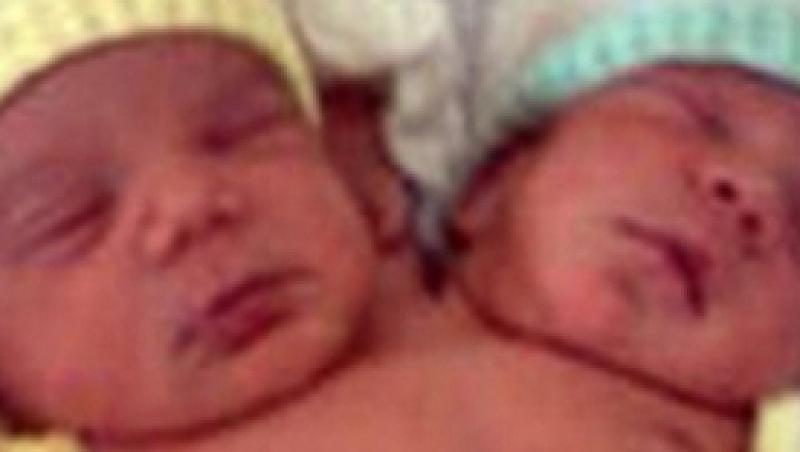 Brazilia: s-a nascut un bebelus cu doua capete
