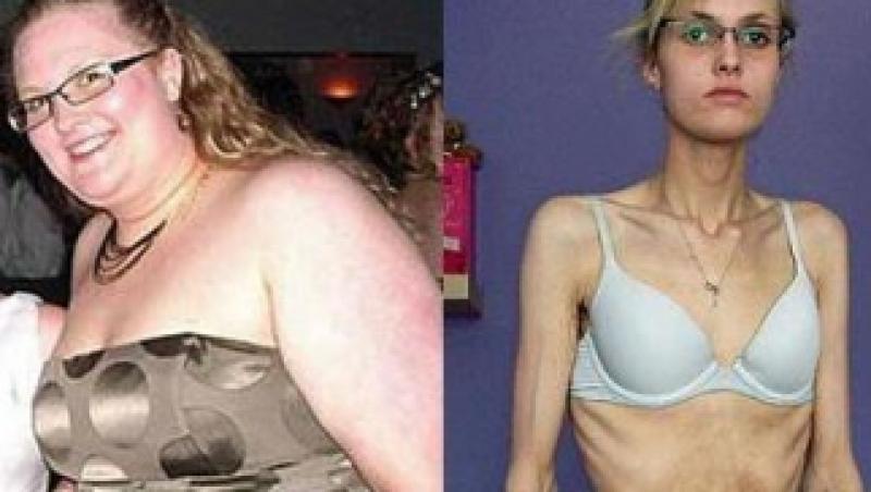 Anorexia, o boala foarte periculoasa in randul tinerilor
