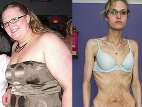Anorexia, o boala foarte periculoasa in randul tinerilor