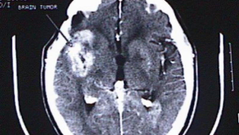 Studiu: Cazurile de tumoare cerebrala s-au inmultit de 5 ori in ultimii 10 ani