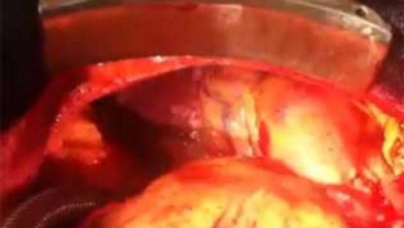 VIDEO! Operatie medicala rara: Doua inimi bat in acelasi piept